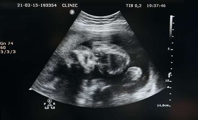 Early pregnancy ultrasound scan