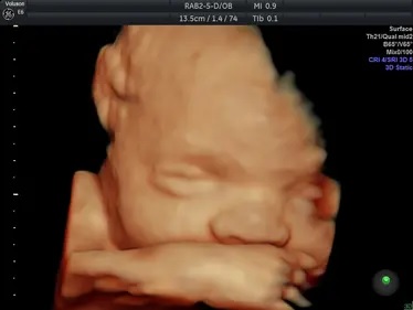 4D scan of a baby in the womb